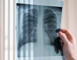 A person holding up a patient's chest Xray.